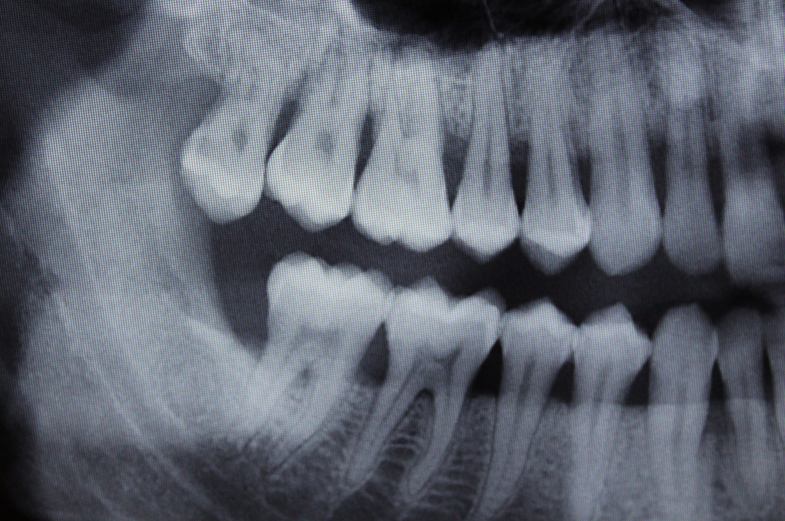xrays xrays